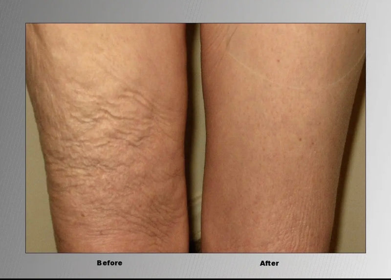 As Seen on Shark Tank: Skinnies Instant Lift Thigh Lift